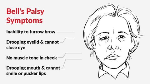 Bell's Palsy: A Journey Through Misdiagnosis, Global Challenges, and AI-Driven Hope